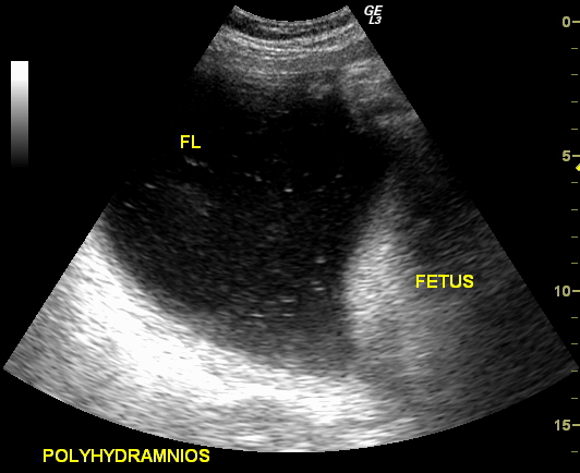 low amniotic fluid at 20 week ultrasound