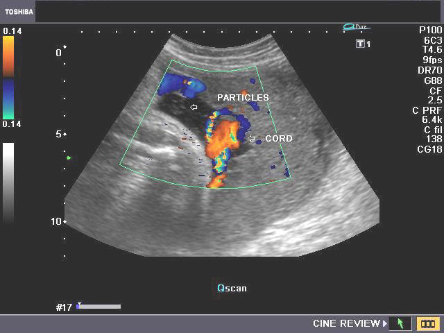 low amniotic fluid ultrasound