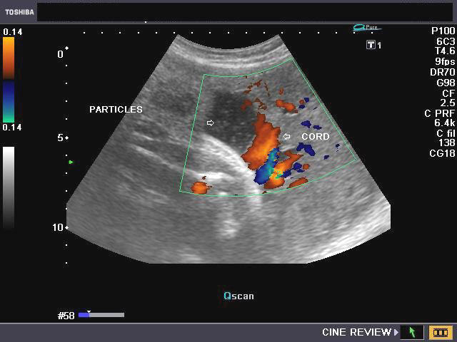 low amniotic fluid ultrasound