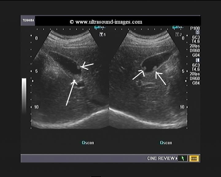 diseased gallbladder ultrasound