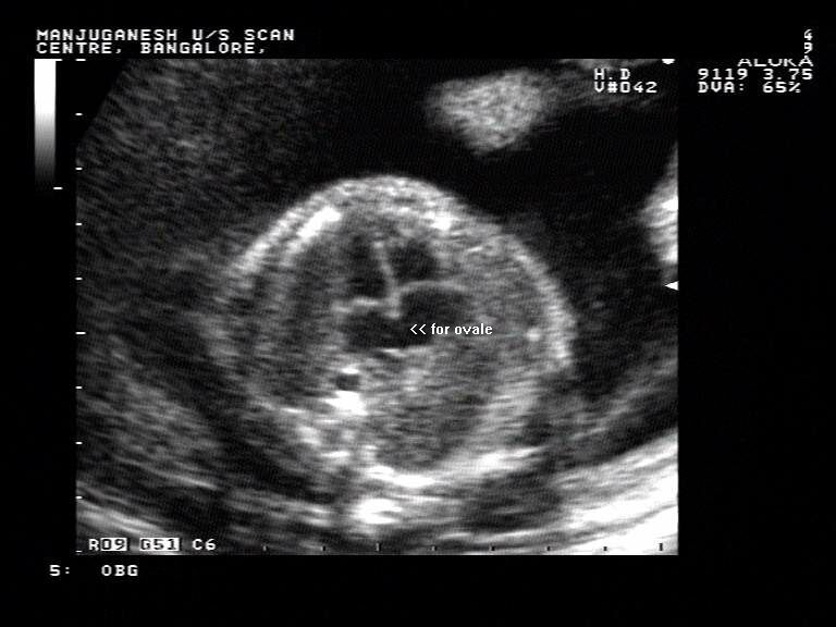 fetal heart monitor