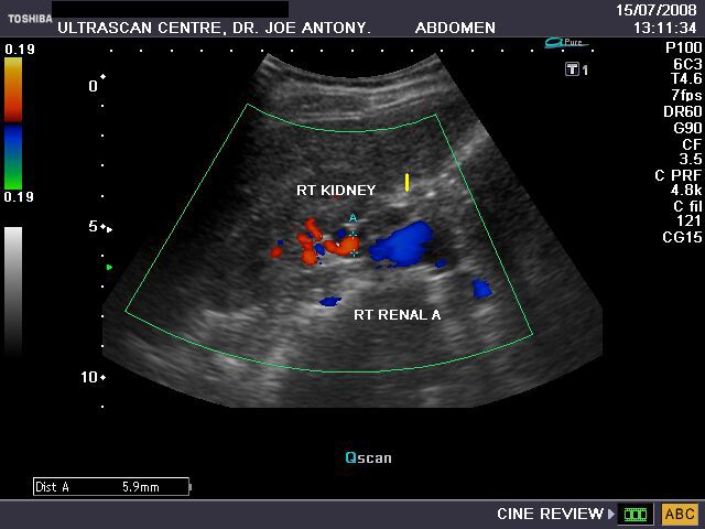 renal artery doppler ultrasound