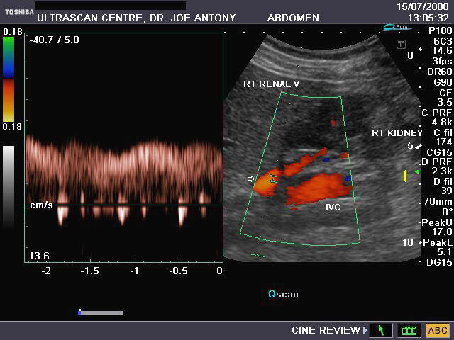 renal artery doppler ultrasound