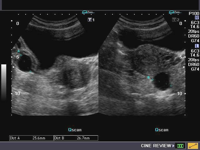 healthy ovarian ultrasound