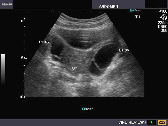 healthy ovarian ultrasound