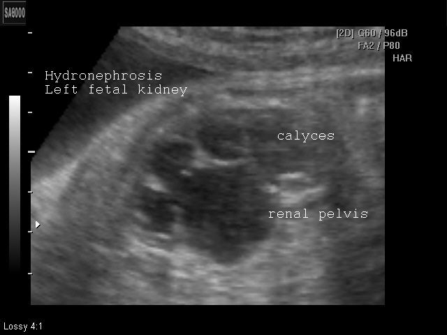 adult polycystic kidney disease ultrasound