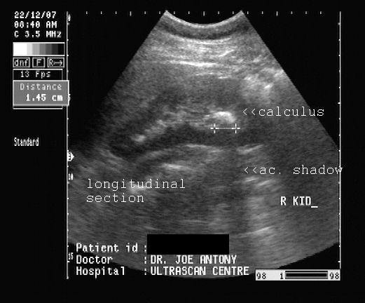 staghorn calculus right kidney