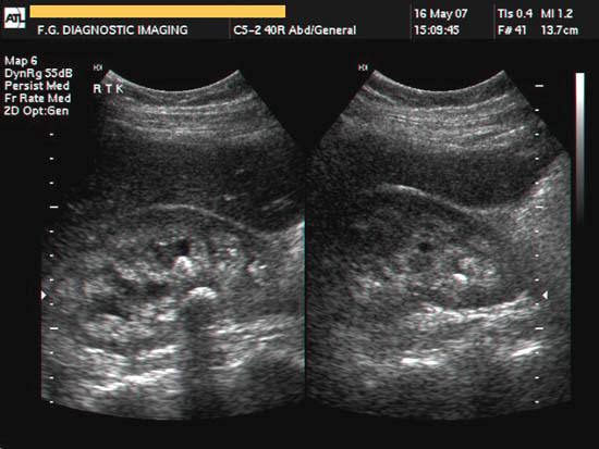 what do kidney stones look like on ultrasound