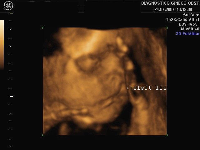 cleft lip 2d ultrasound