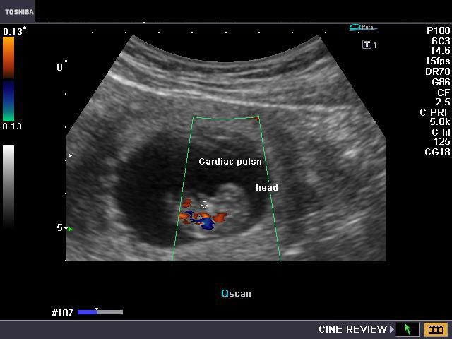 sonoline b fetal doppler 9 weeks