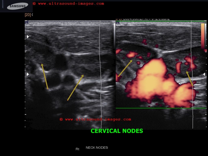shotty lymph node ultrasound