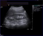 Rt. kidney shows duplication of pelvicalyces: Ultrasound images